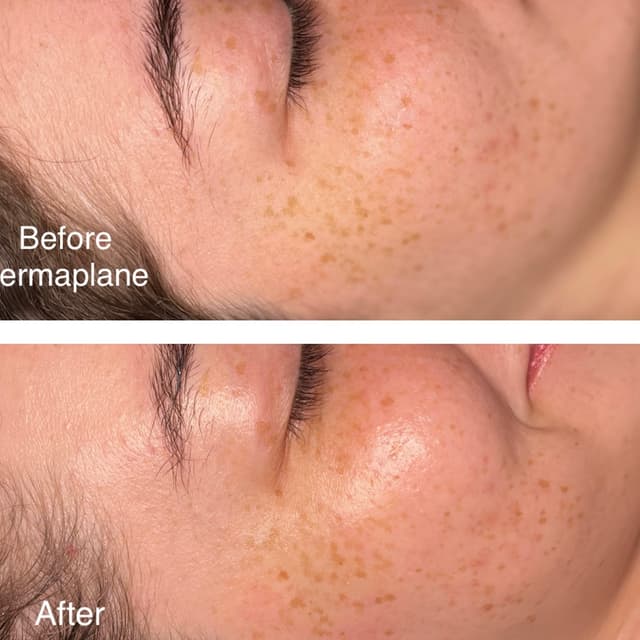 Dermaplane pkg of 2/$195 at Skin-Centric in San Antonio, TX